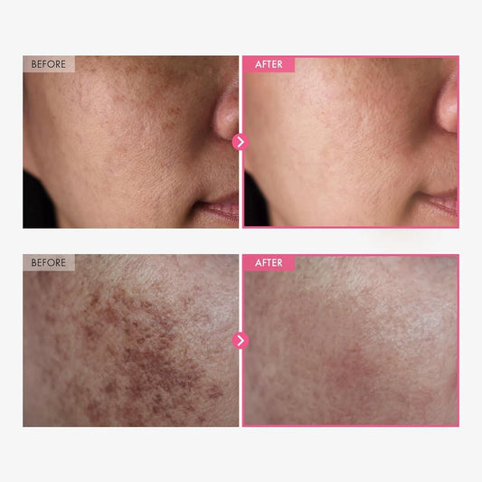 TOSOWOONG Dark Spot Cream